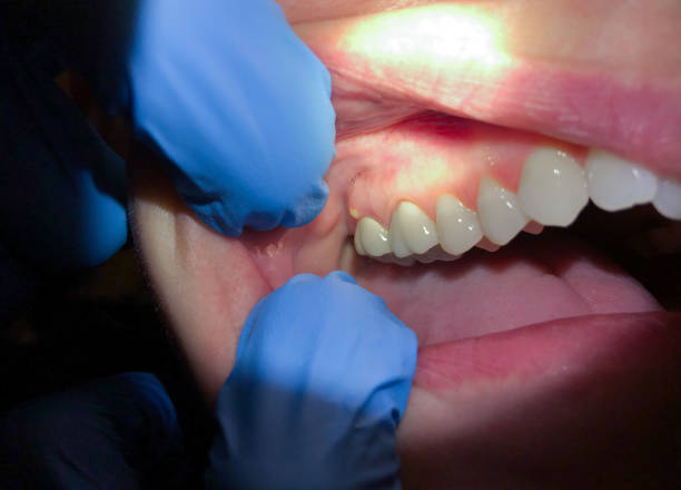 Best Emergency Dental Care for Abscessed Tooth in Statesboro, GA